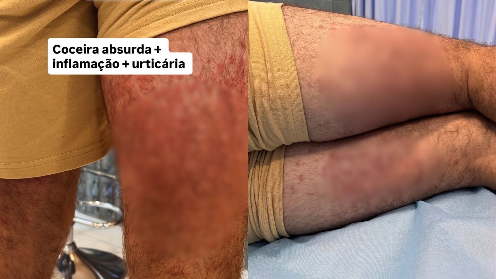 Ex-ator da Globo é hospitalizado na Indonésia após inflamações na pele por motivo surpreendente: "fui devorado"