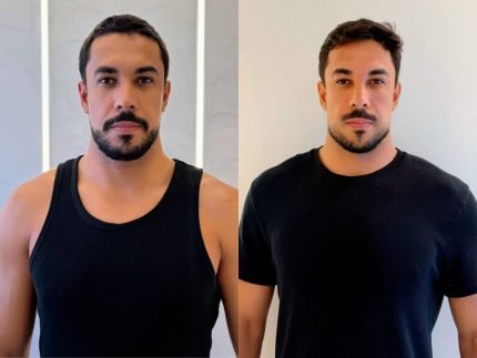 Ex-BBB Maike Allan faz harmonização facial e explica receio de perder a naturalidade